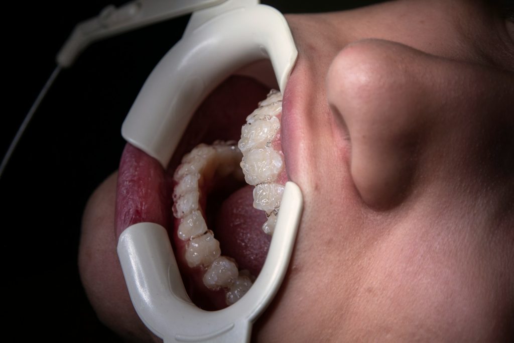 teeth whitening