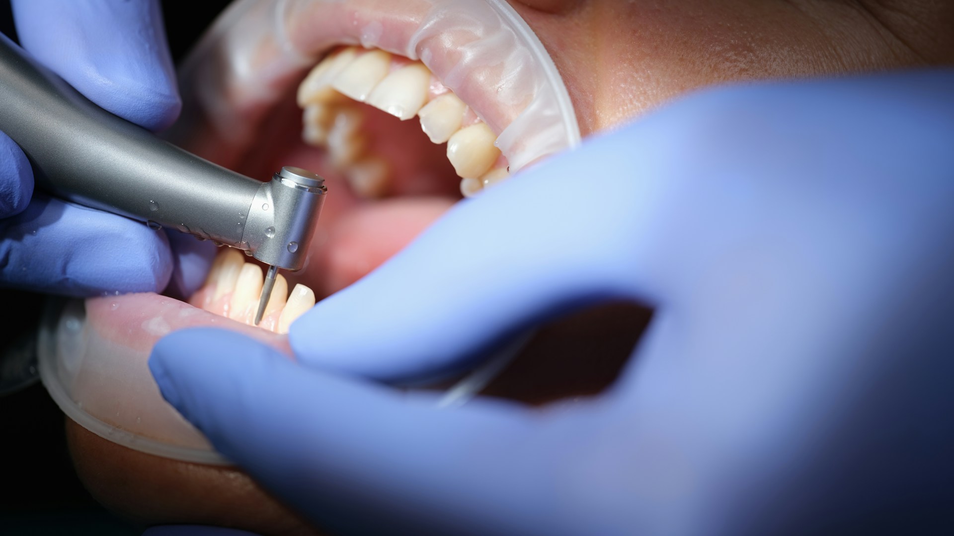 dental crown